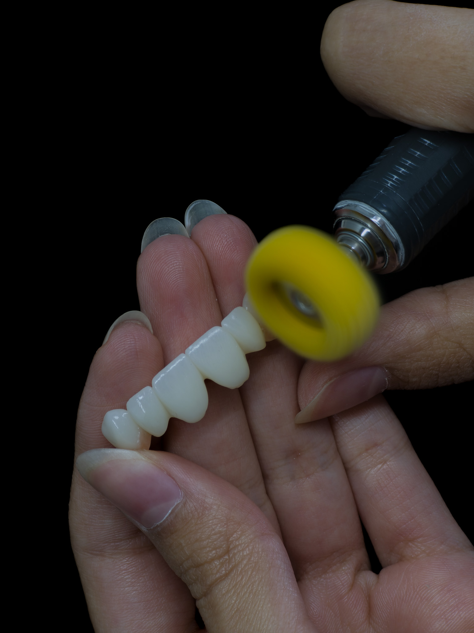 Zirconia Bridge Restoration