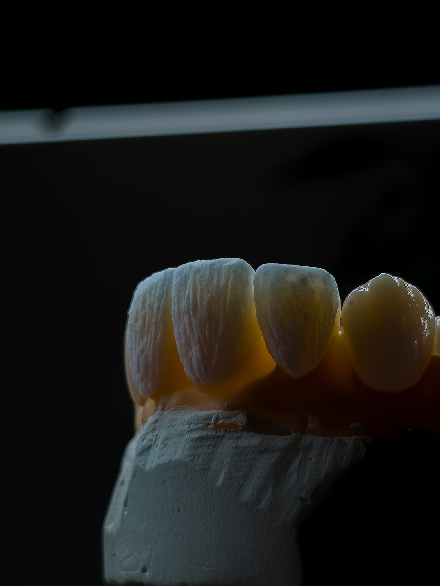 Anterior E-max Veneers