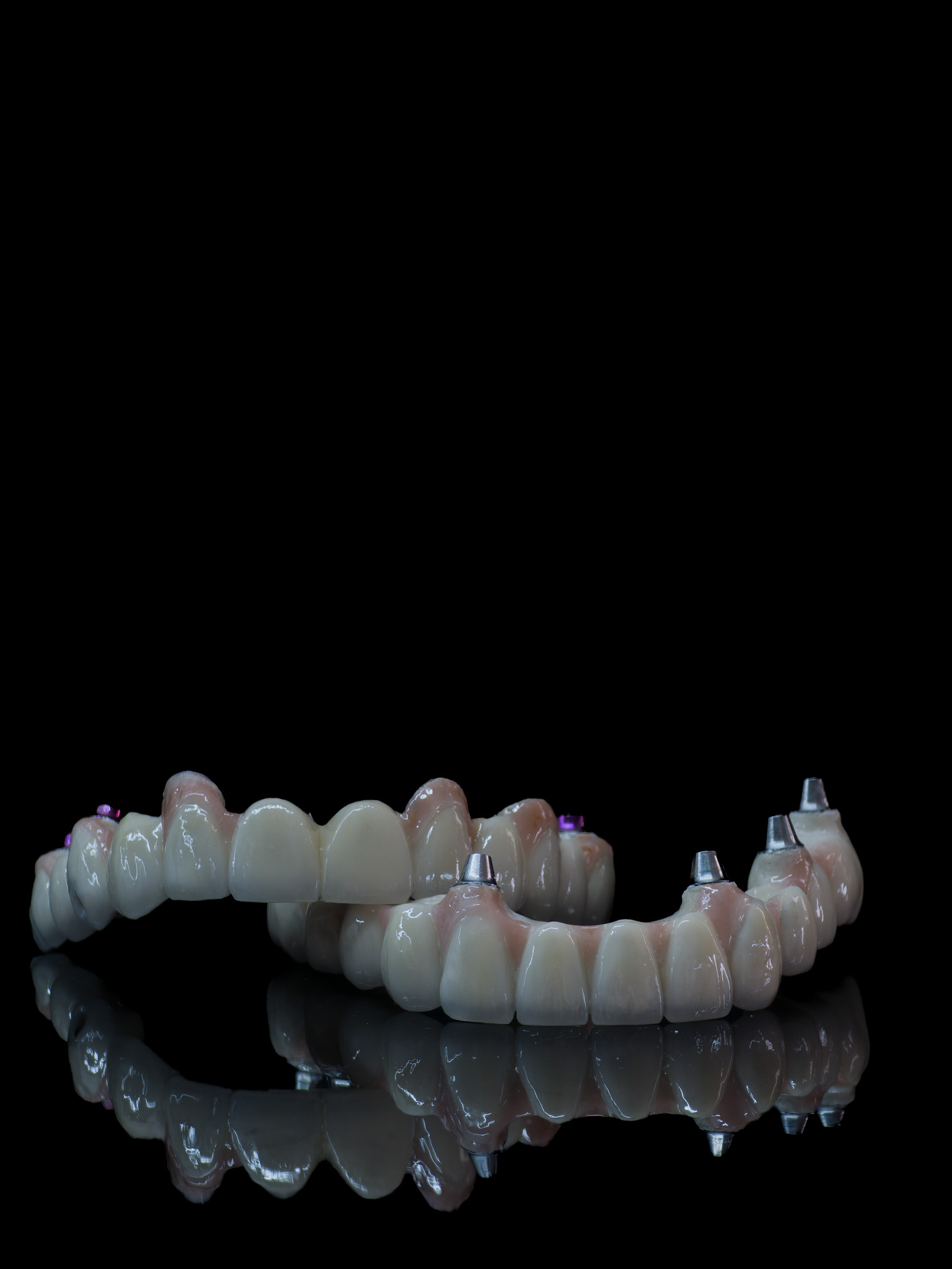 PFM Implant Restoration